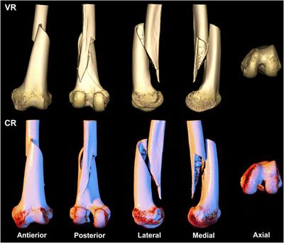 Cinematic rendering improves the AO/OTA classification of distal femur fractures compared to volume rendering: a retrospective single-center study